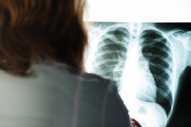 Photo xray cancer check doctor with a picture of the lungs and chest in a medical clinic evaluates the patients health