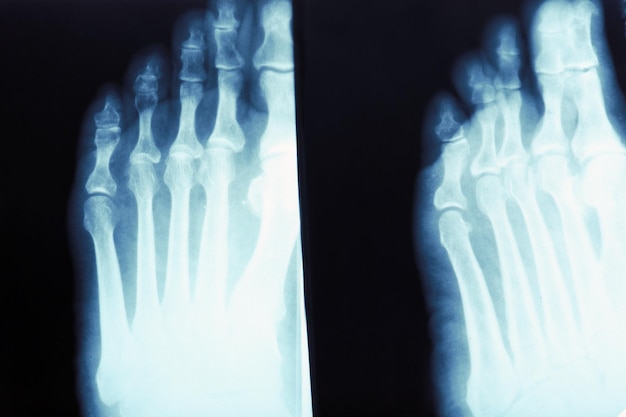 Photo xray of feet closeup