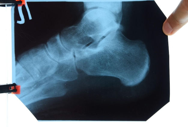 Photo xray of feet and heel bones x ray picture of bones