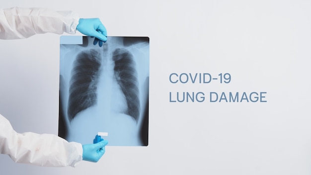 Xray film of Covid 19 lung damage and holding by doctor hand in medical glove and PPE or Personal