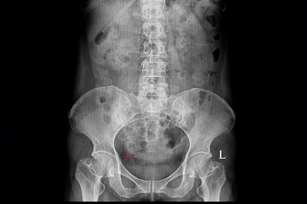 Рентгеновская пленка больного с правым дистальным отделом мочеточника