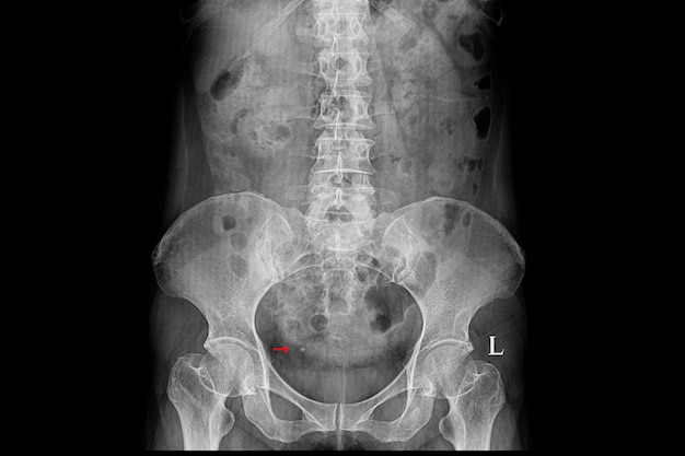 Photo xray film of a patient with right distal ureteric stone