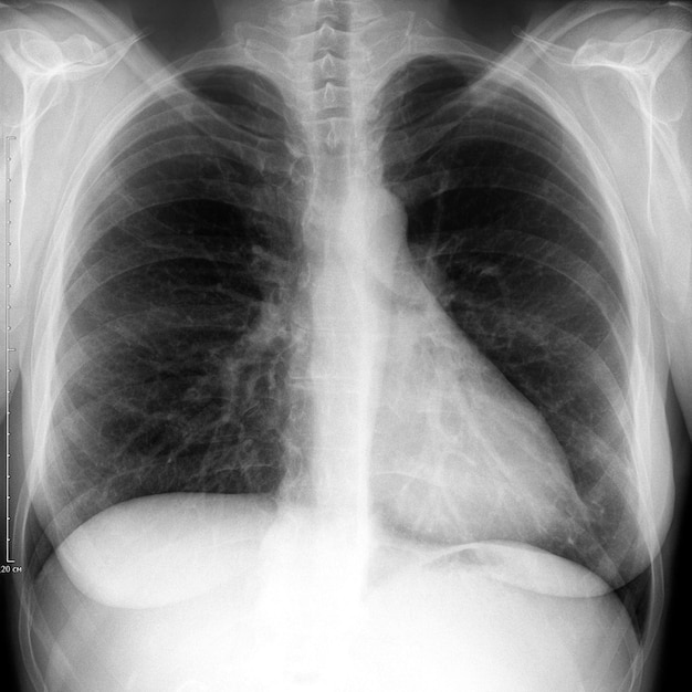 의료 진단을 위한 인간 가슴의 XRay 이미지