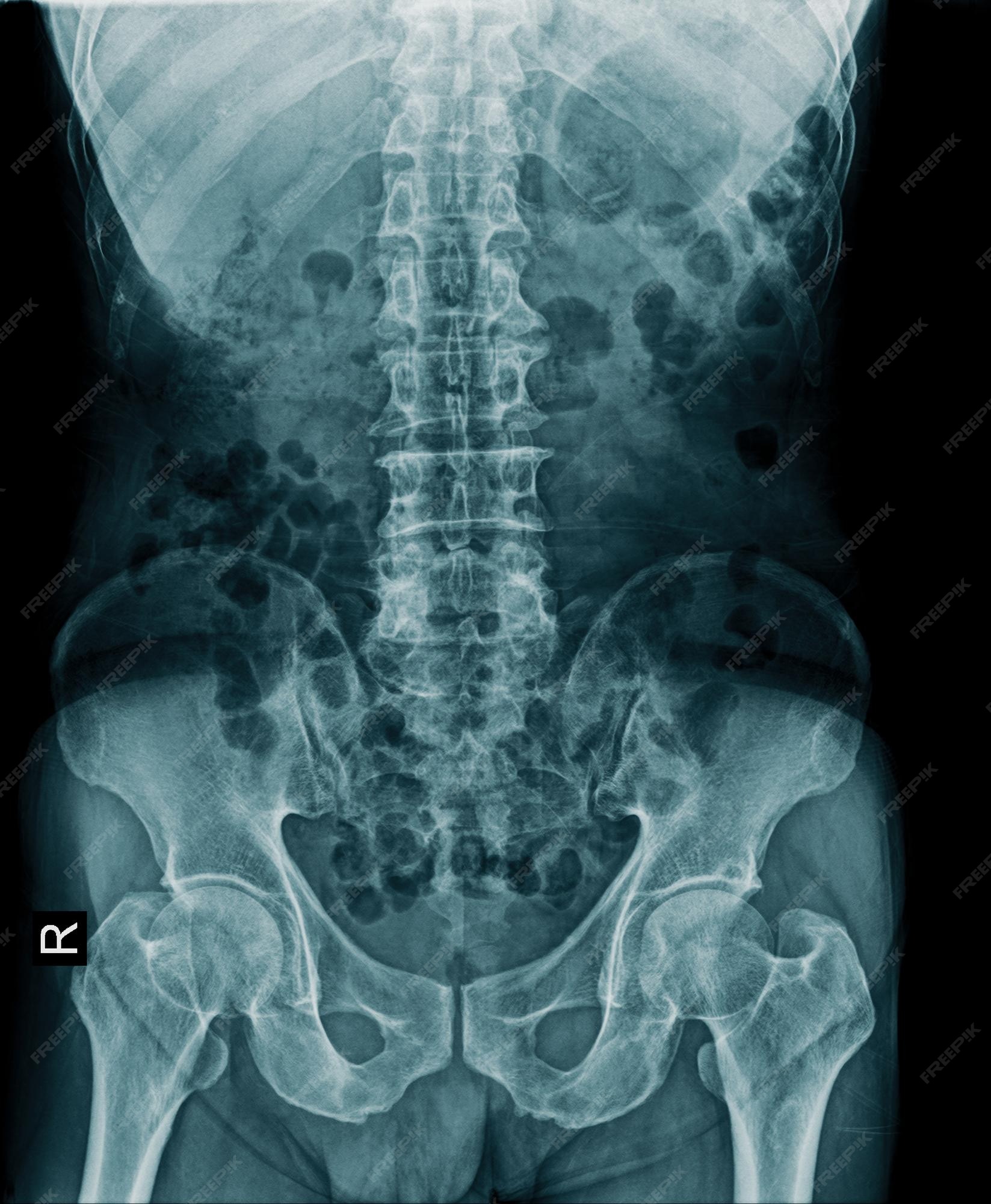 sacrum anatomy xray