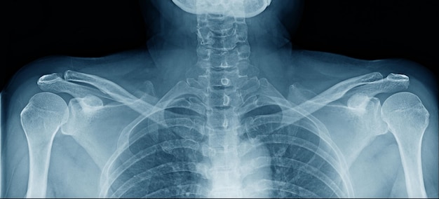 Xray image of upper part of human body