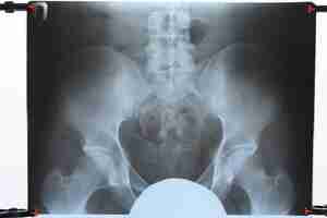 Photo xray of the pelvis and sacrum xray