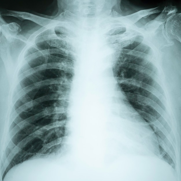 XRay radiation image of Chest report