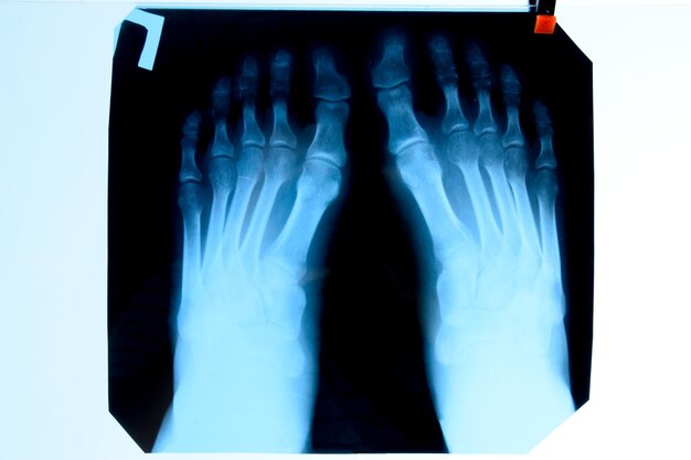 Photo xray of toes foot on xray bone research