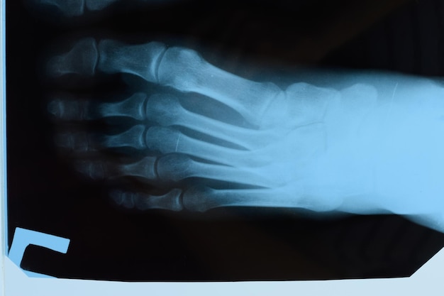 Photo xray of toes foot on xray bone research
