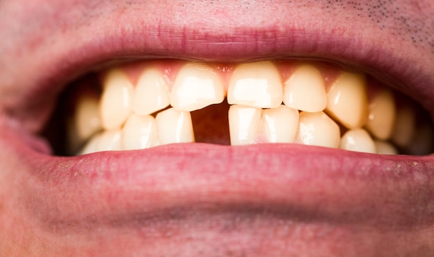 Желтые плохие зубы. Человек без одного переднего зуба. Зубов нет.