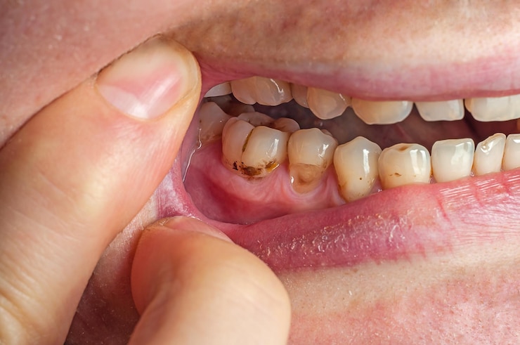 Photo yellow teeth with plaque closeup the filling fell off the tooth