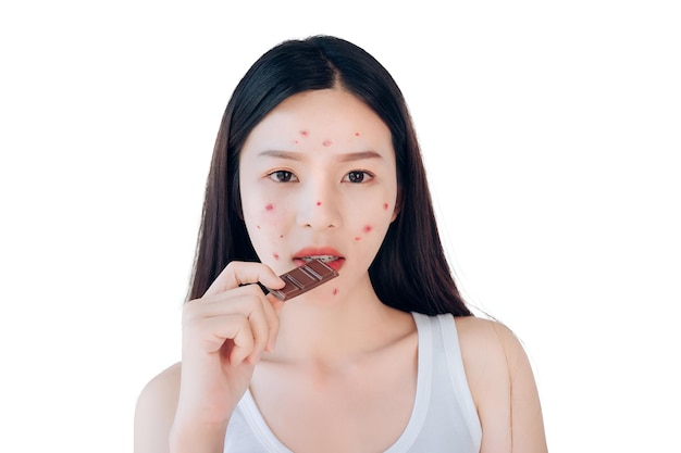 Young Asian woman Acne Problem Face Eating Chocolate bar on white isolated background