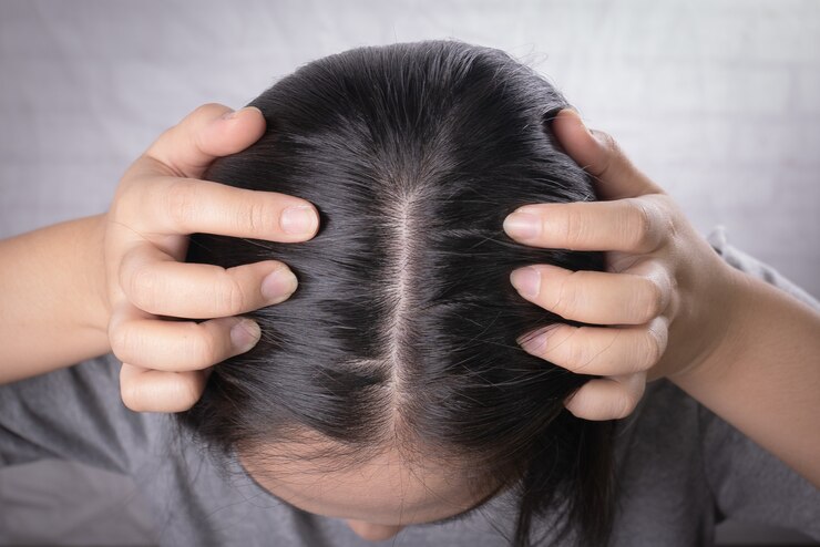 Photo アジアの若い女性は、脱毛、頭のはげ、フケの問題が心配です。