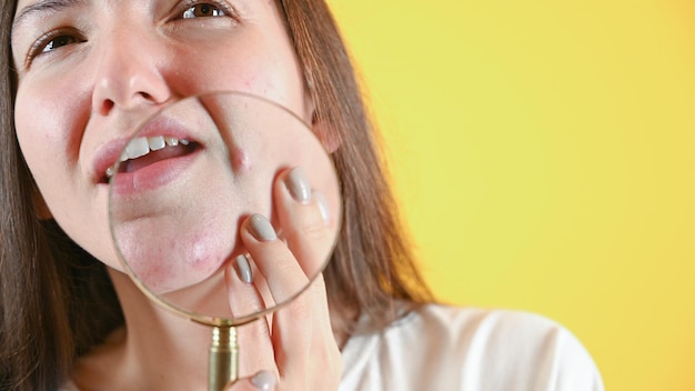 Young brunette who checks her skin with magnifying glass on yellow background Skin allergy concept facial rashes High quality photo