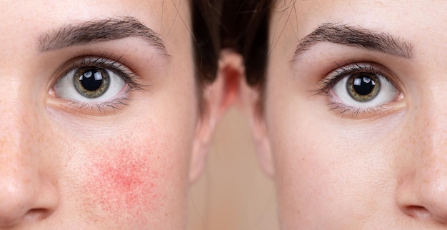 Photo a young caucasian girl shows the before and after results of intensive light surgery to remove the symptoms of rosacea. a noticeable reduction in cheek redness is seen.