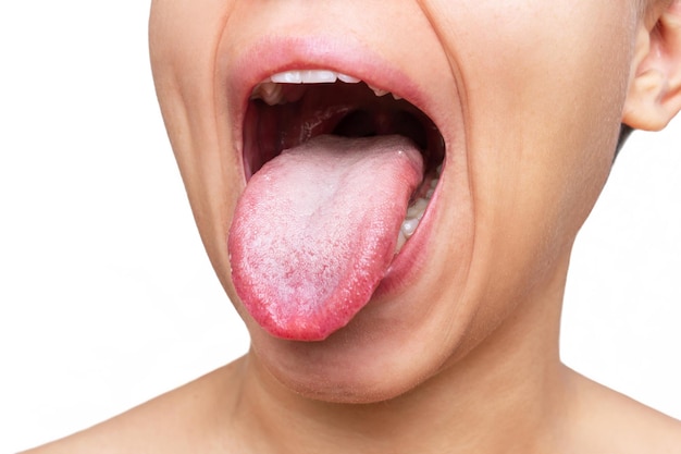 Young caucasian woman showing tongue with a white plaque isolated on a white background