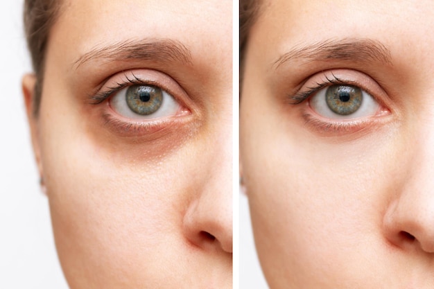 Photo a young caucasian womans face with dark circles under eyes before and after cosmetic treatment