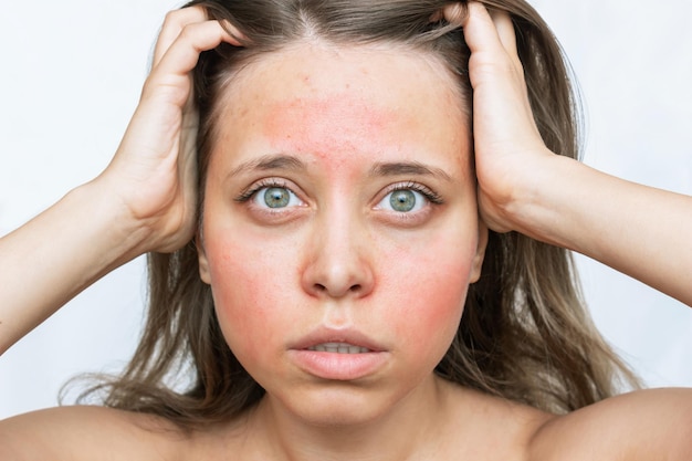 뺨과 이마에 붉은 알레르기 발진이 있는 백인 걱정스러운 젊은 여성. 얼굴에 알레르기