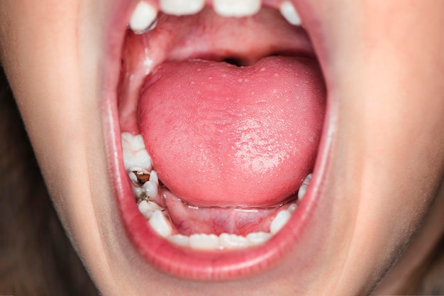 Una giovane ragazza urla per il mal di denti. problemi dentali nei bambini. carie precoce e denti cariati. il concetto di cura per il cavo orale.