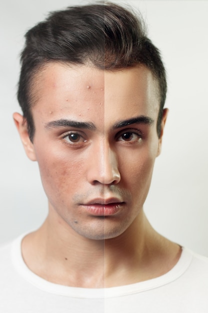 Young man before and after cosmetic or plastic procedure