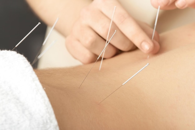 Photo young man getting acupuncture treatment closeup