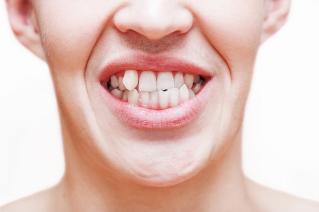 Young man showing crooked growing teeth. The man needs to go to the dentist to install braces.