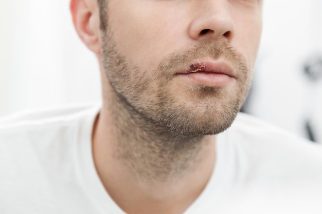 Photo young man suffering from herpes on his mouth