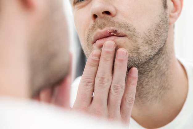 Photo young man suffering from herpes on his mouth