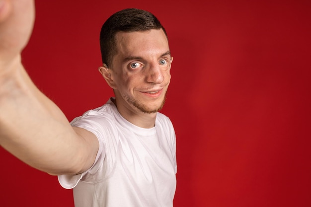 Photo young man in white tshirt with treacher syndrome takes selfies people with disabilities genetic disease