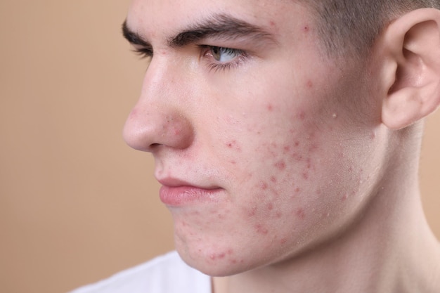 young man with acne problem on beige background closeup