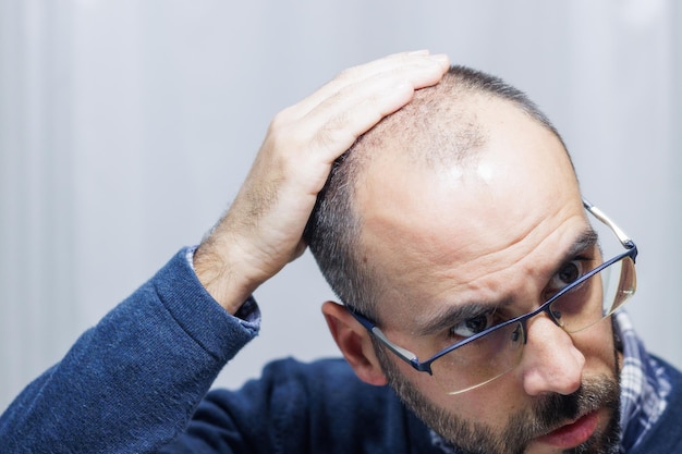 Giovane con alopecia che si guarda la testa e i capelli allo specchio