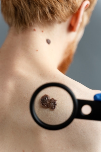 Photo young man with moles on back back view