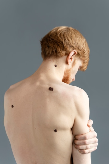 Photo young man with moles on back medium shot