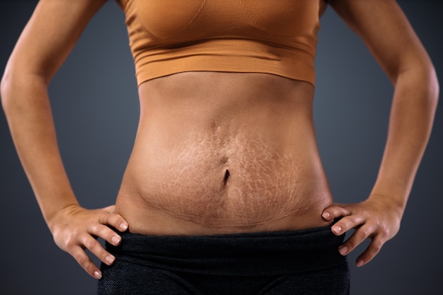 Young mum standing with hands on hips and showing her belly full of stretch marks after pregnancy.