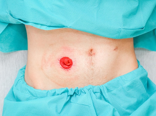 Photo a young patient in pajamas with an open stomach postoperative scars and a clean intestine out