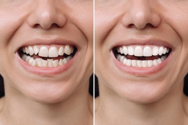 young smiling woman before and after veneers installation correction of uneven teeth with