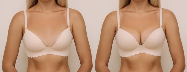 Young tanned blonde woman in bra before and after breast augmentation with silicone implants