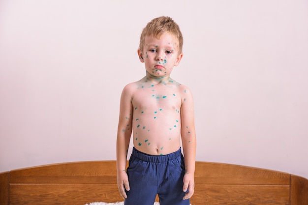 Young toddler, boy with chickenpox. sick child with chickenpox.
varicella virus or chickenpox bubble rash on child body and
face.