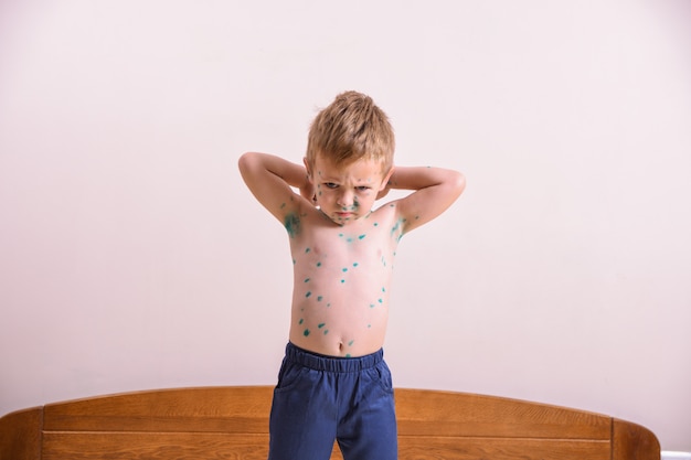 Young toddler, boy with chickenpox. sick child with chickenpox.\
varicella virus or chickenpox bubble rash on child body and\
face.