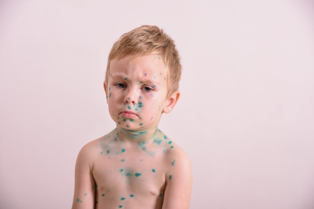 Young toddler, boy with chickenpox. sick child with chickenpox.\
varicella virus or chickenpox bubble rash on child body and\
face.