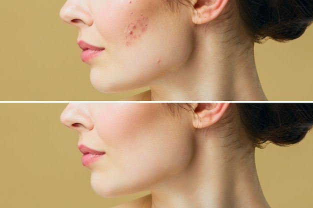 Giovane donna prima e dopo il trattamento dell'acne. concetto di cura della pelle.