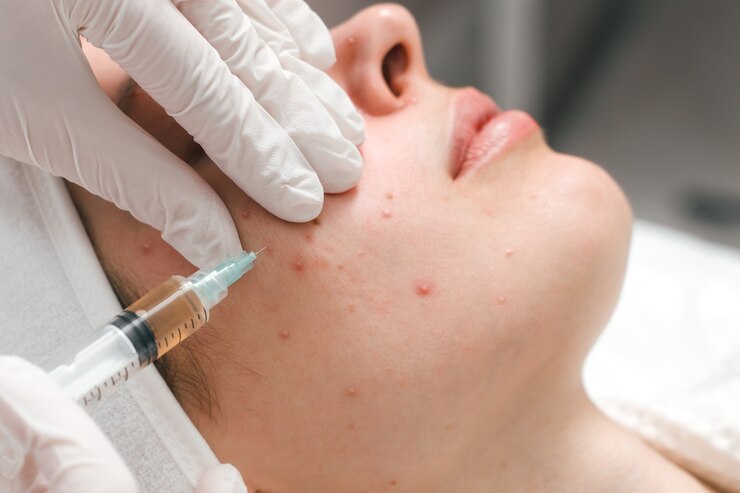 Photo a young woman in a cosmetology clinic undergoing acne treatment with injections an effective remedy