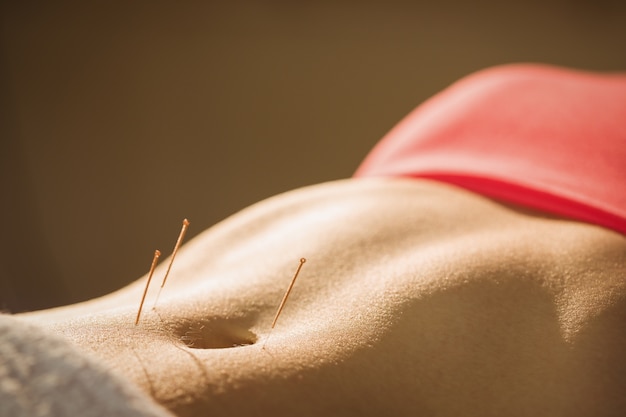 Young woman getting acupuncture treatment