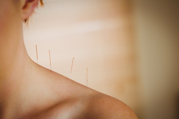 Young woman getting acupuncture treatment