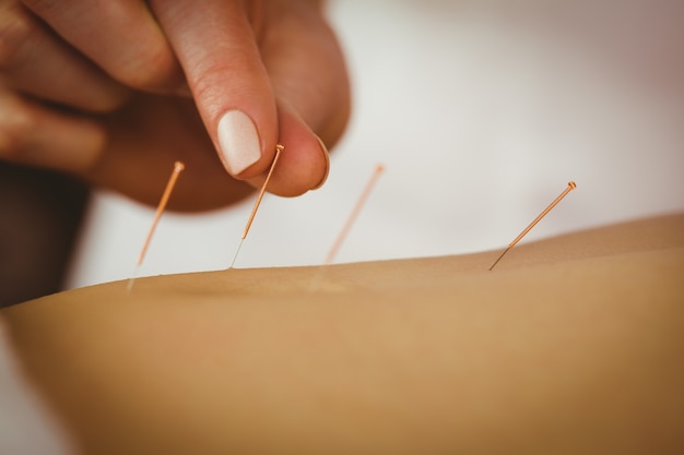 Photo young woman getting acupuncture treatment