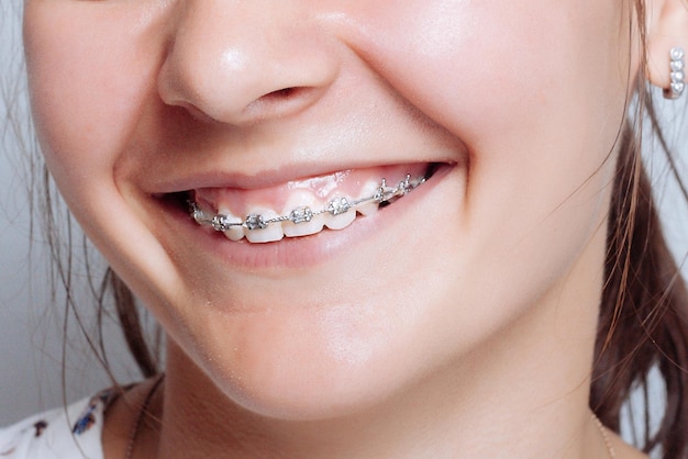 Young woman portrait with dental braces natural