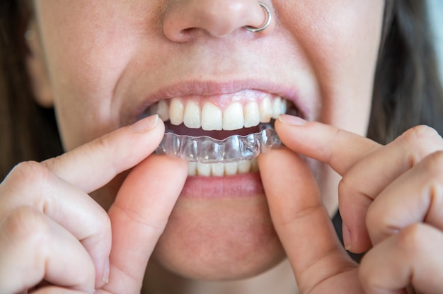 young woman putting on an invisible dental aligner.
