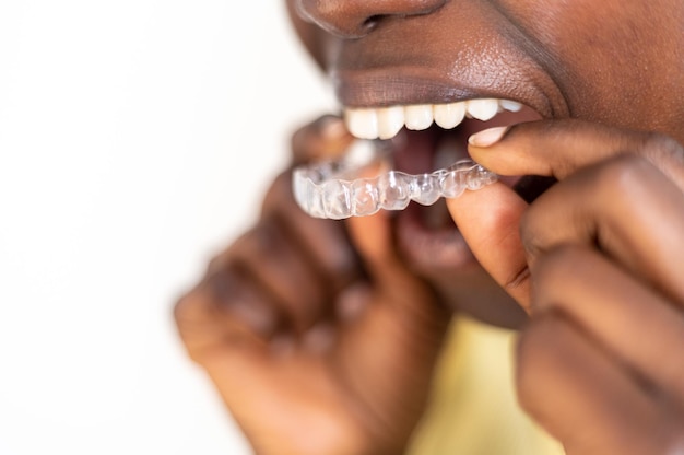 Young woman putting on an invisible dental aligner.