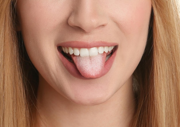 Young woman showing tongue with white patches closeup Oral candidiasis thrush disease