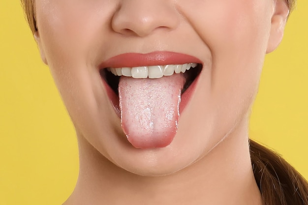 Young woman showing tongue with white patches on yellow background closeup Oral candidiasis thrush disease